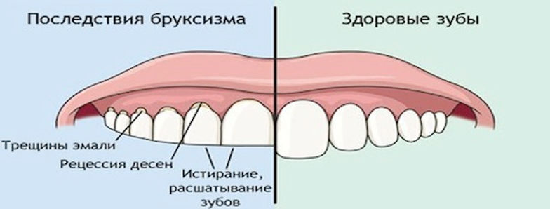 Почему ребенок скрипит зубами во сне