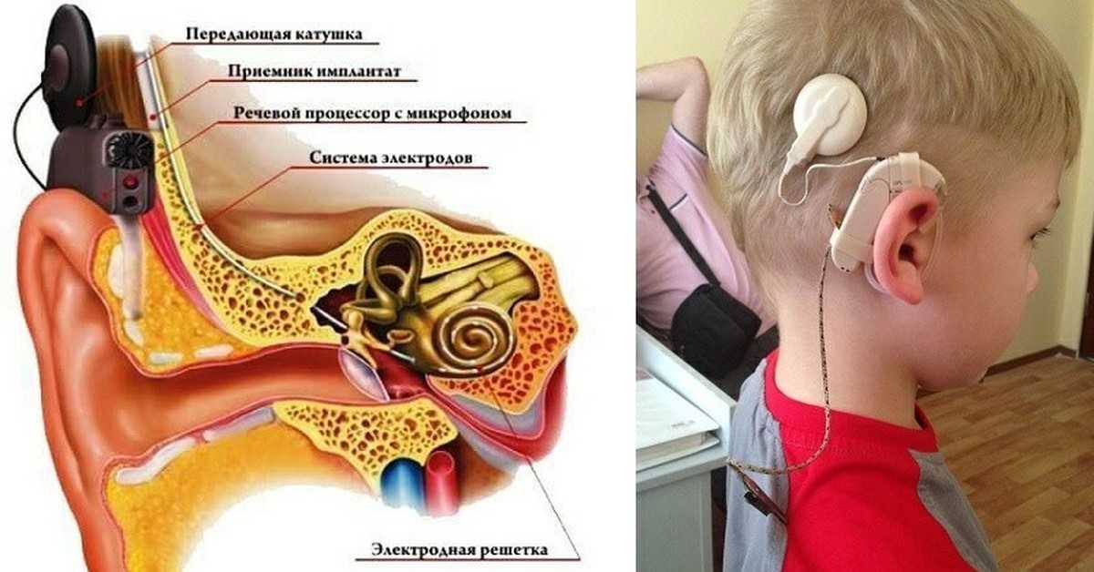 Серная пробка в ухе: удаление, промывание, симптомы, признаки