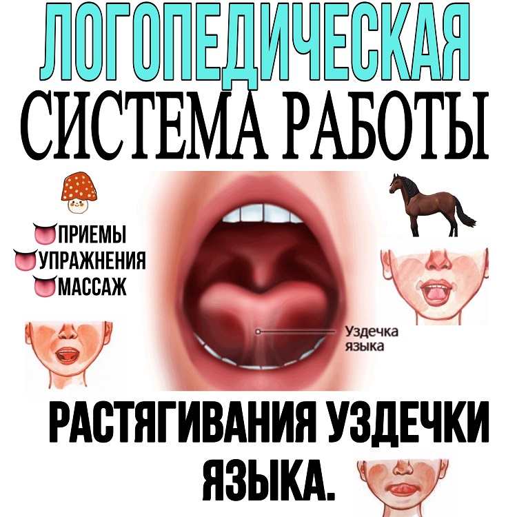 Как короткая уздечка может влияет на речь ребенка? | центр анны семкиной