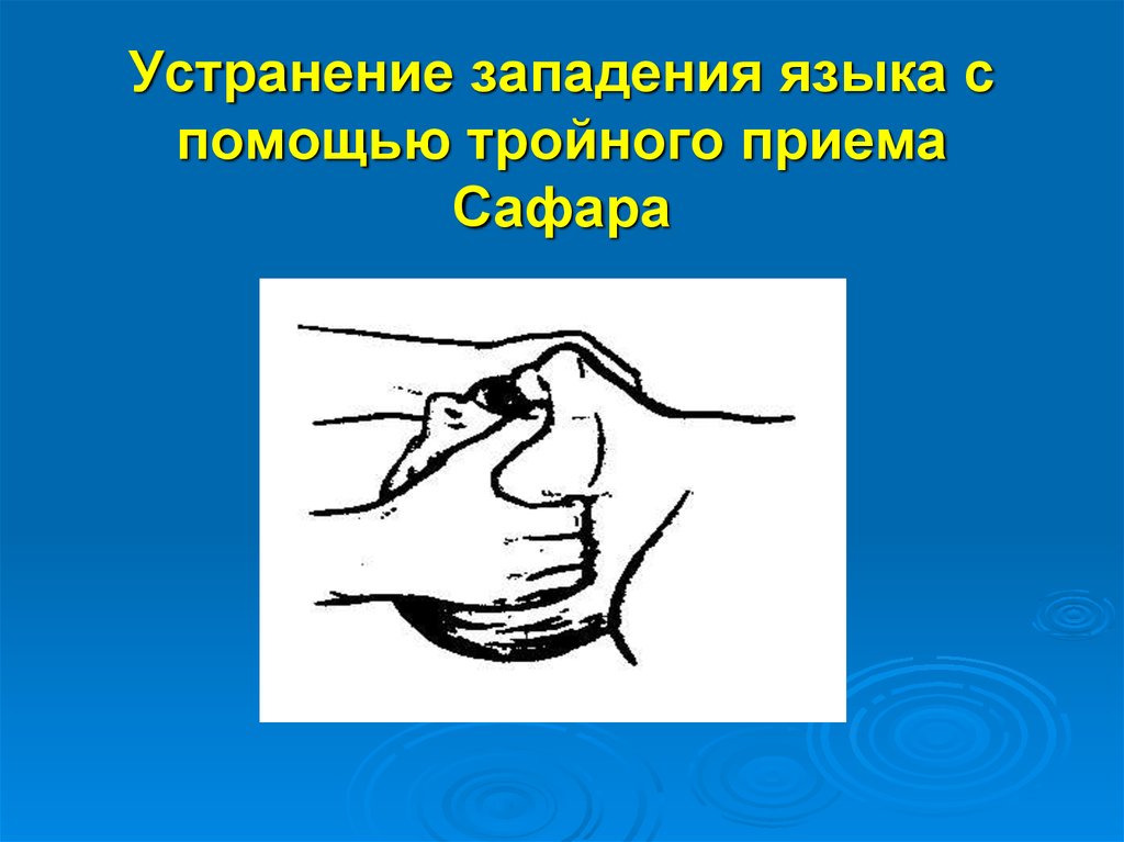 Неестественное положение языка во рту - описание симптома, при каких болезнях, какие врачи лечат и необходимые процедуры