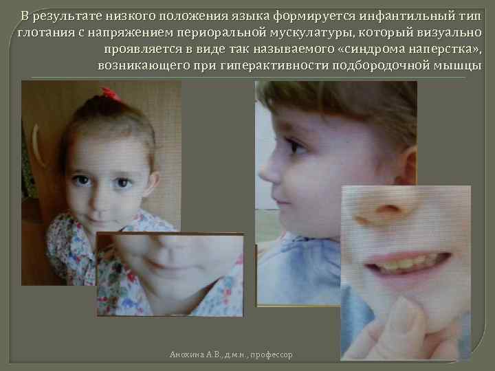 Инфантильный тип глотания