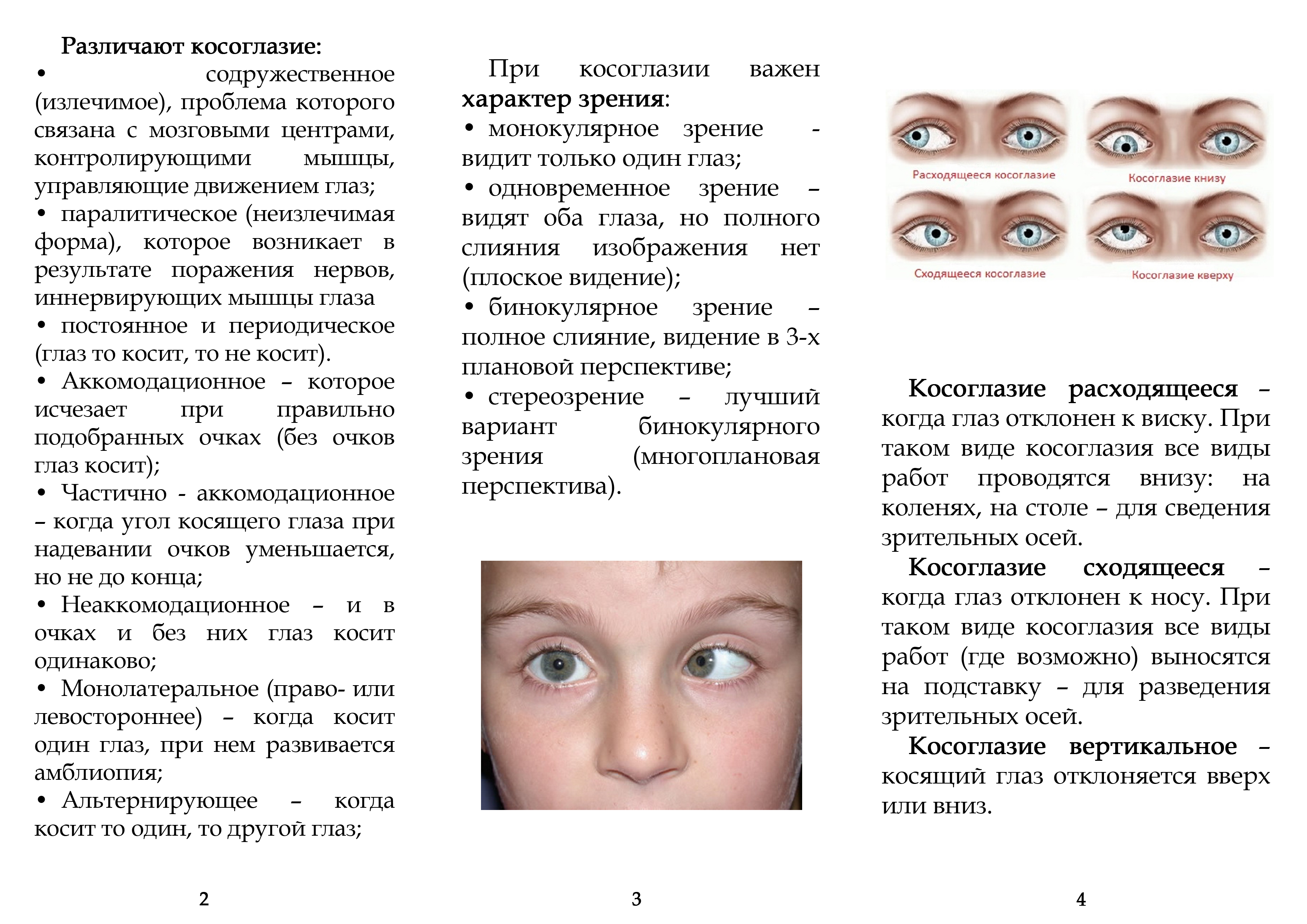 Косоглазие у детей причины, лечение, виды