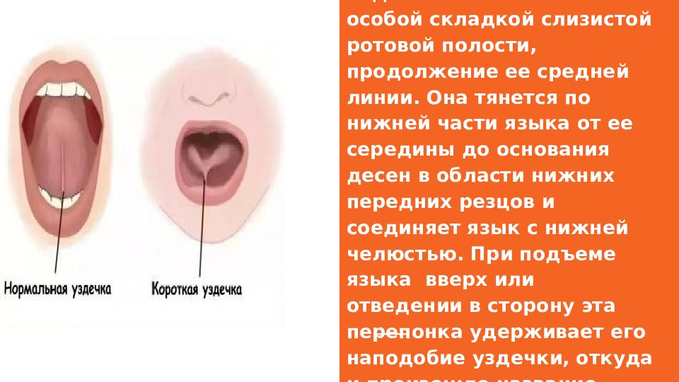 Короткая уздечка языка — что делать?