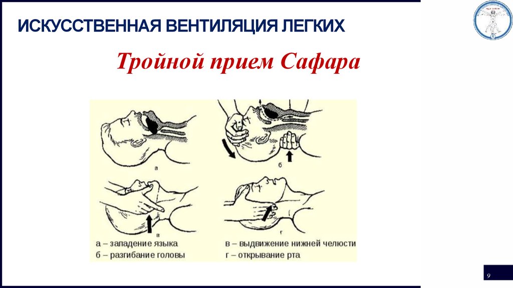 Дизартрия
