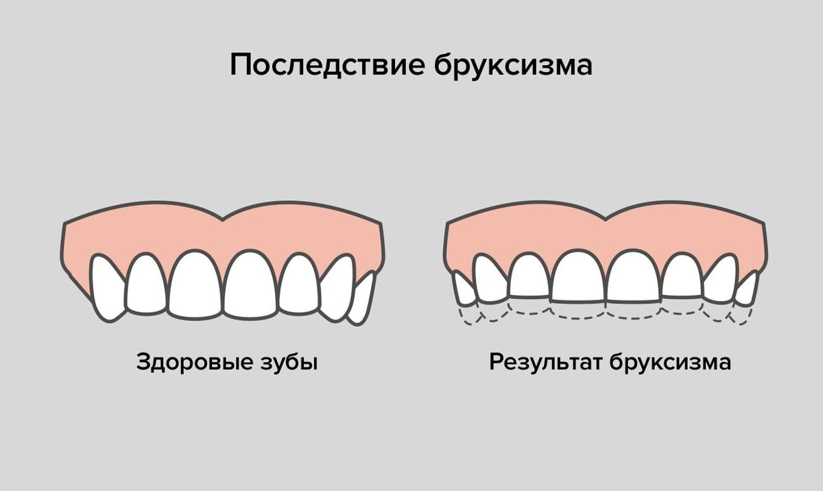 Бруксизм у детей явление нередкое которое вызывает массу вопросов у молодых родителей