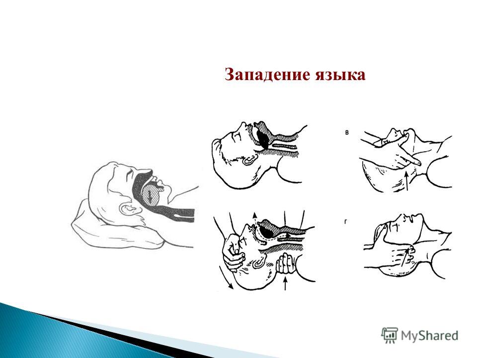 Отклонение языка вправо. оценка неврологического статуса в условиях скорой помощи. лечение девиации языка