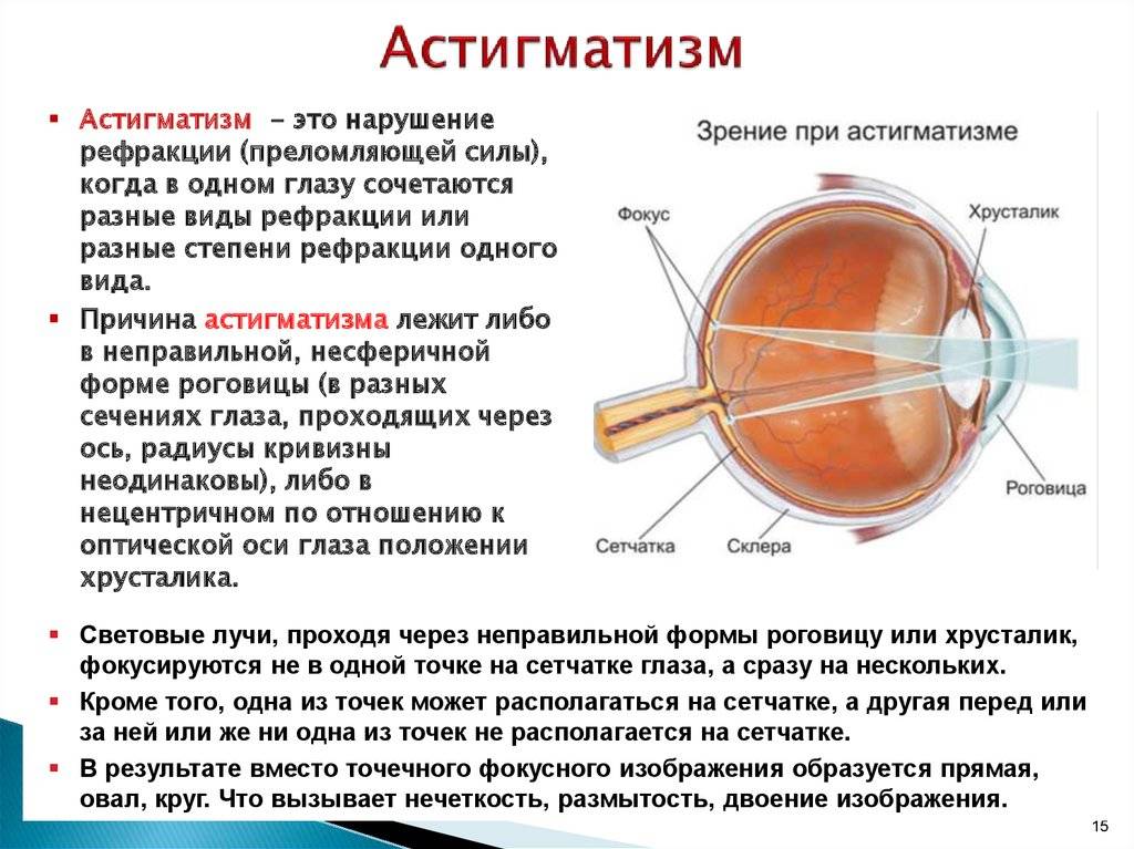 Астигматизм у детей распространенное чаще всего врожденное заболевание