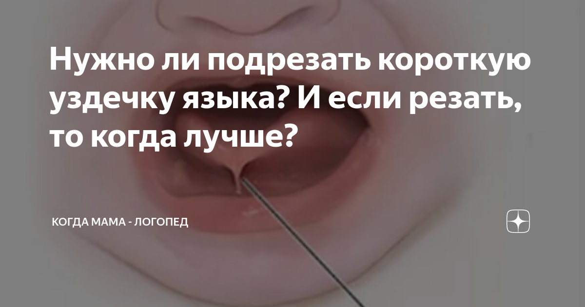 Короткая уздечка языка у новорожденного – причины, симптомы и лечение