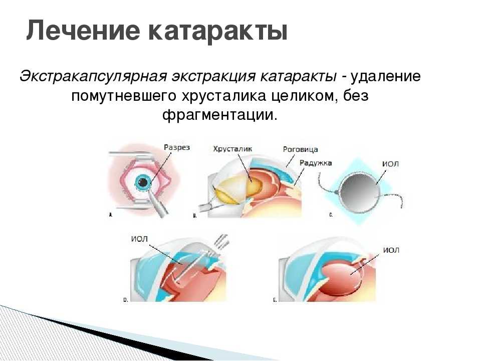 Как не потерять зрение: симптомы заболевания сетчатки - телеканал доктор
