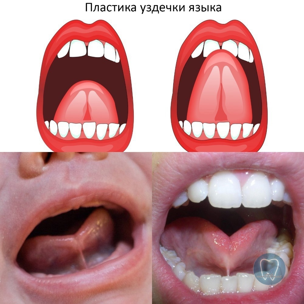 Короткая уздечка языка у ребенка: причины, виды, симптомы у детей разного возраста, прогнозы, мнения врачей