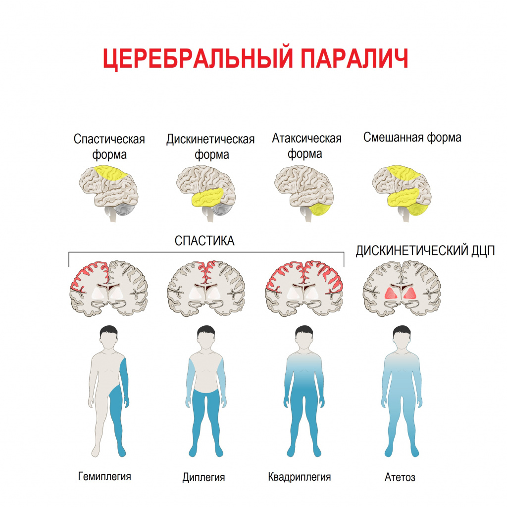 Детский церебральный паралич (дцп): симптомы, причины, реабилитация – напоправку – напоправку