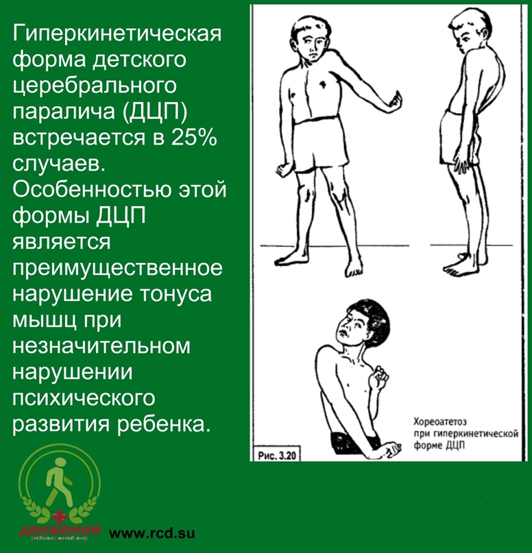Как распознать дцп у ребенка? | аиф югра