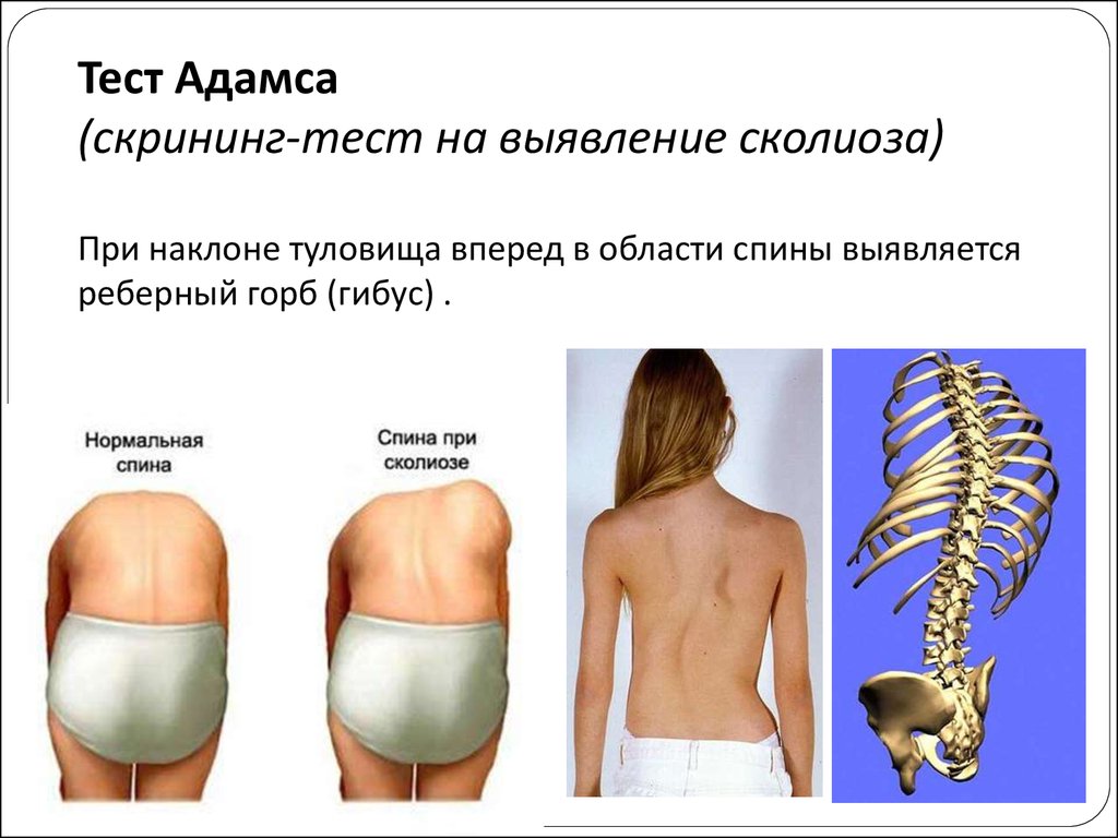 Лечение сколиоза у детей