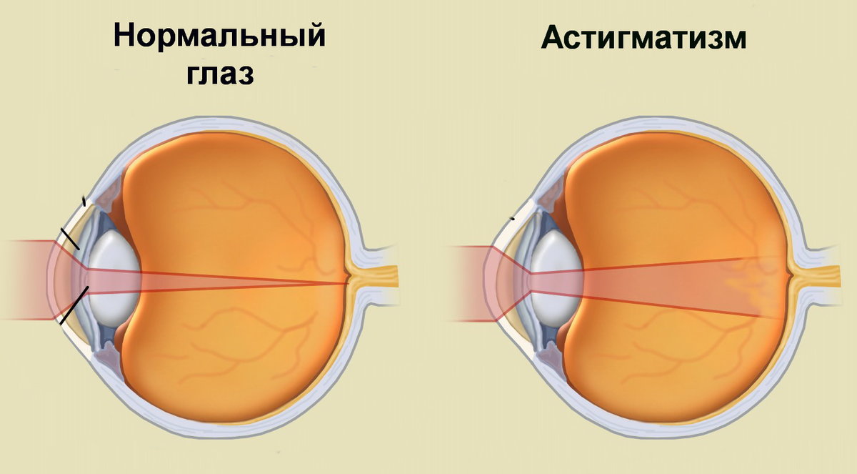 Астигматизм у детей - причины, симптомы, виды