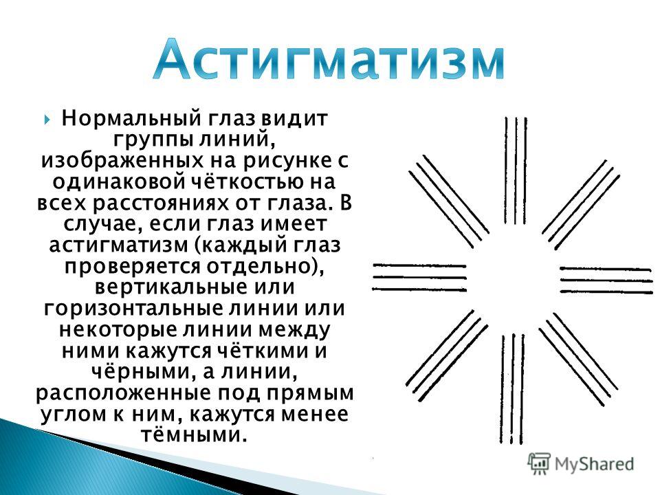 Астигматизм у детей