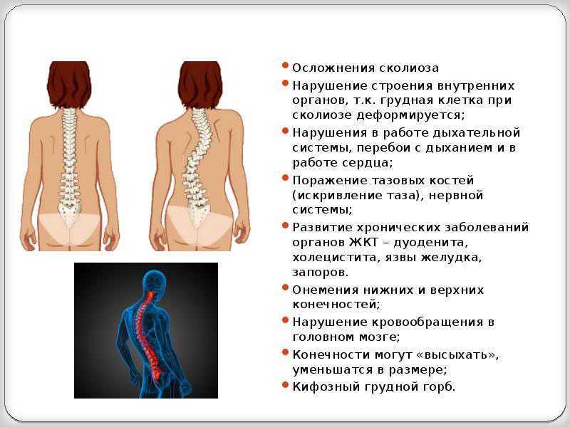 Сколиоз у детей: причины, как лечить в домашних условиях