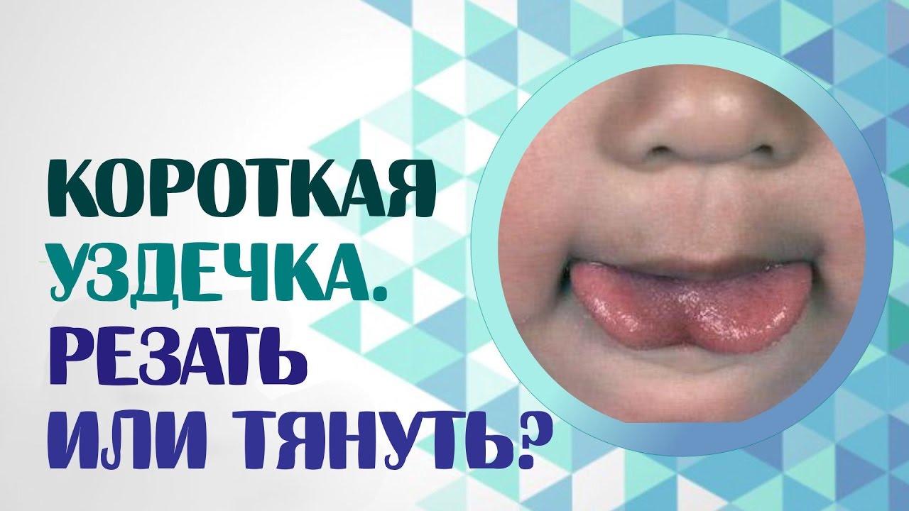 Как распознать и надо ли подрезать короткую уздечку языка у детей – видео операции