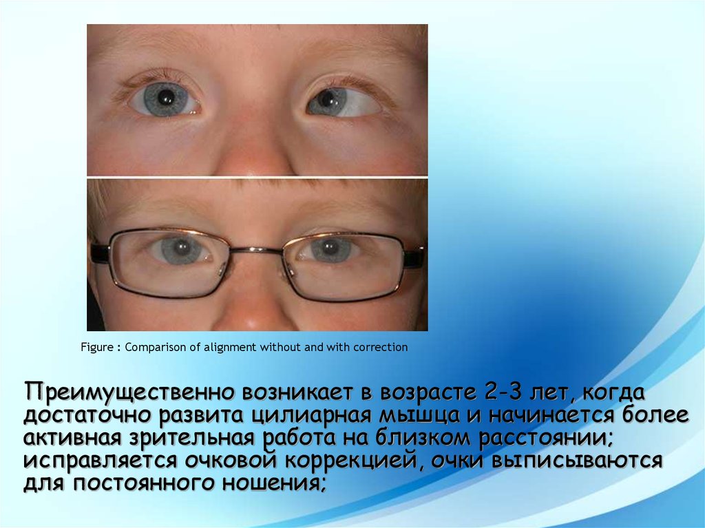 Косоглазие (страбизм): виды, причины и лечение