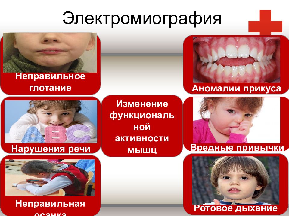 Инфантильный тип глотания